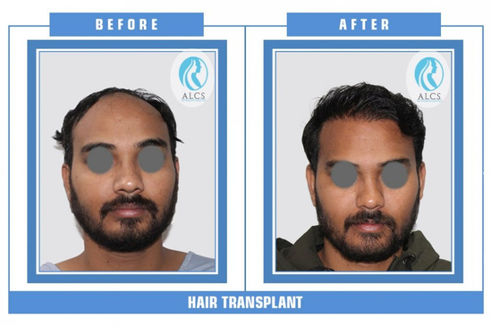 Slider image (4) ALCS - Hair Transplant &  Cosmetic Clinic